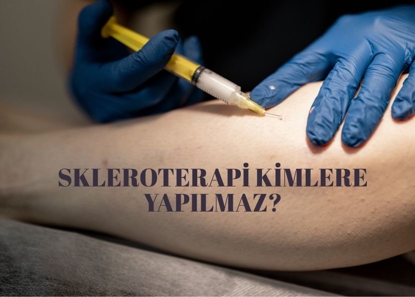 Skleroterapi Kimlere Yapılmaz?