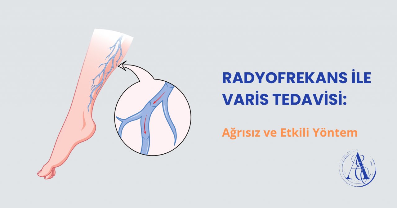 Radyofrekans ile Varis Tedavisi