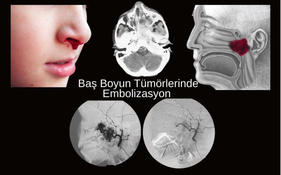 Baş Boyun Tümörü Embolizasyon