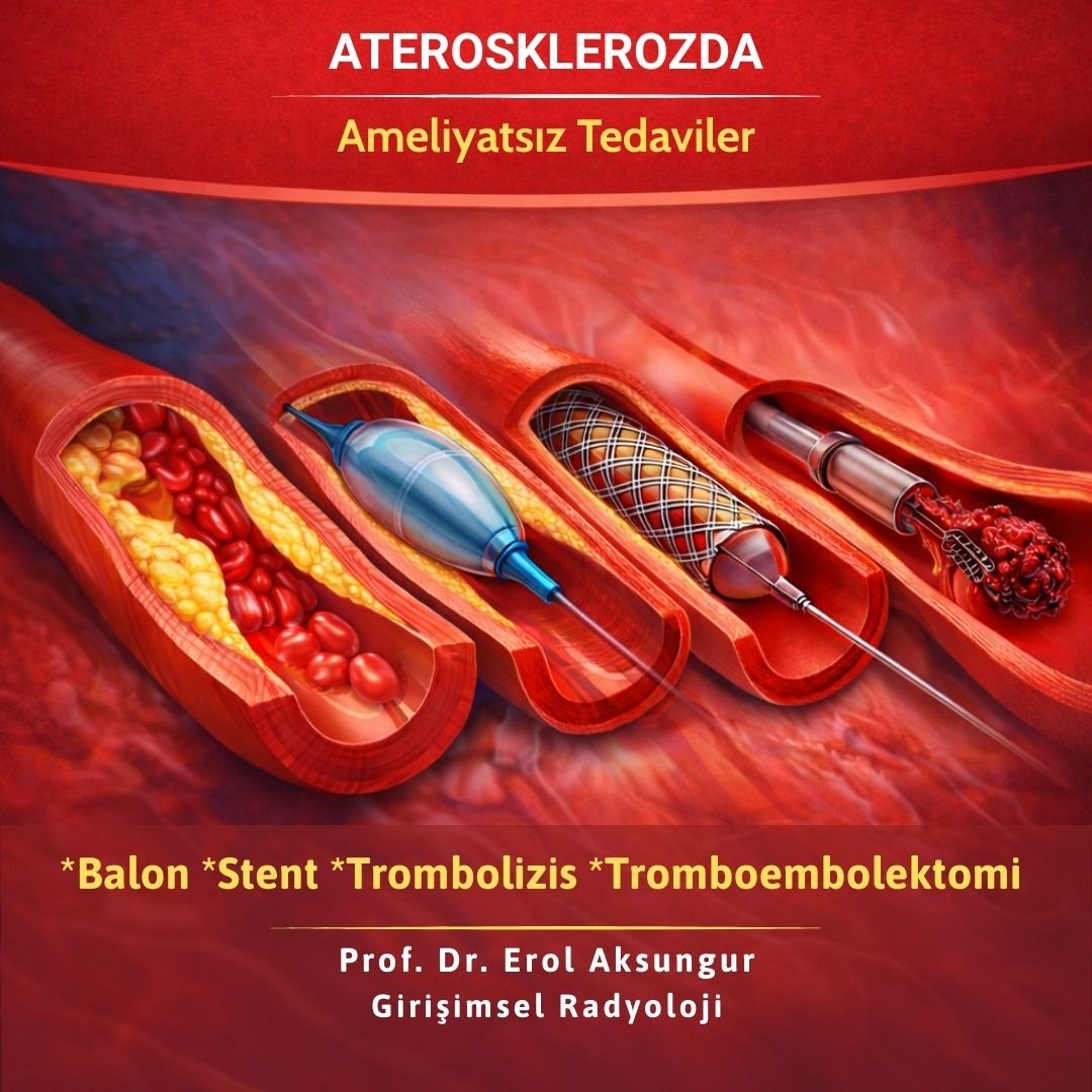 Aterosklerozda Girişimsel Radyoloji: Balon, Stent ve Tromboembolektomi