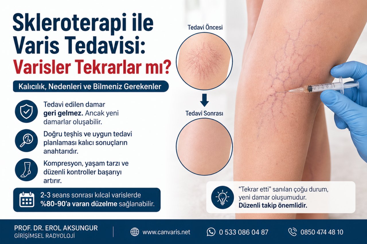 Skleroterapi ile Varis Tedavisi Kalıcı mı? Varisler Tekrarlar mı?