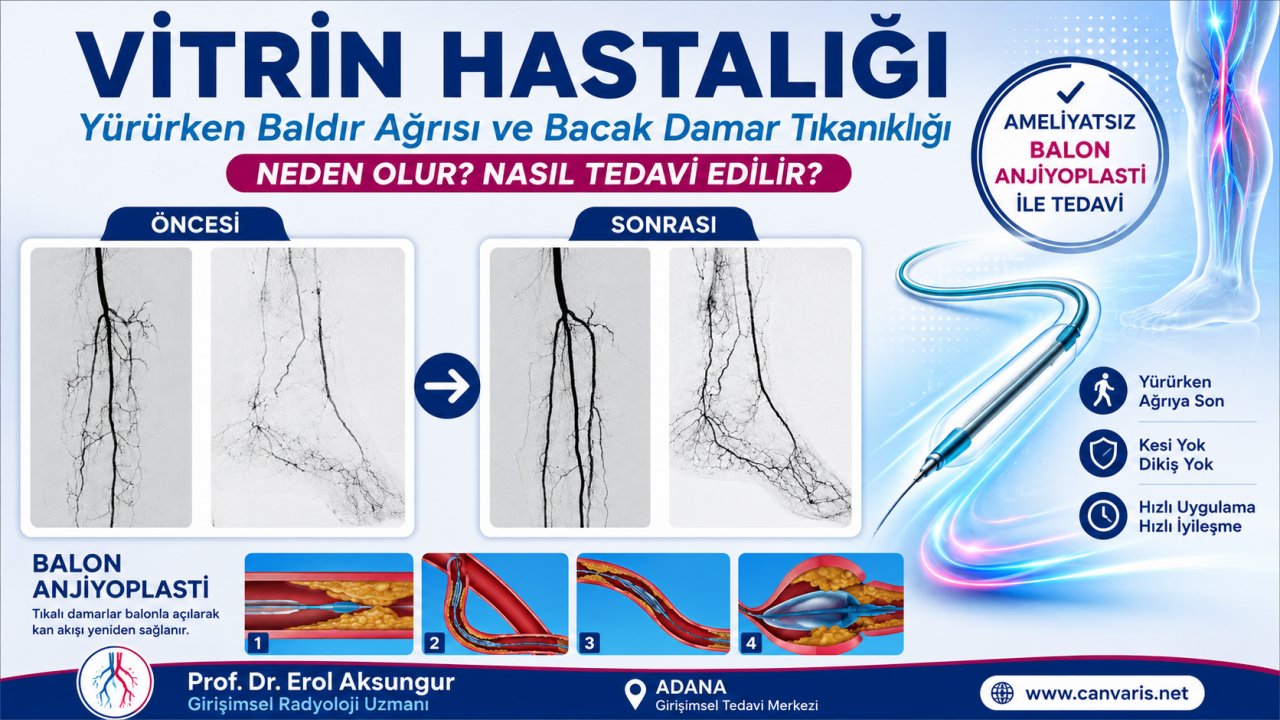 Vitrin Hastalığı Bacak Damar Tıkanıklığı